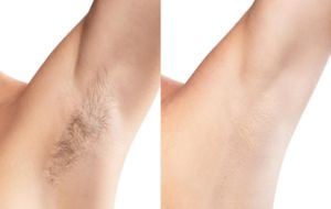 under arm hair removal