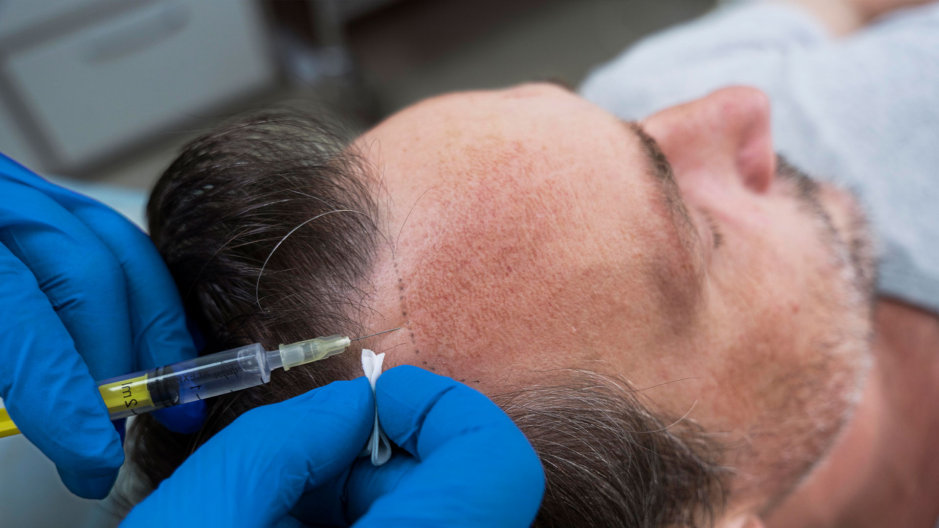 Hair Transplant in Delhi: Cost, Procedure, and Things to Consider