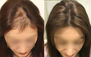 hair prp treatment for female