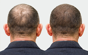 Hair loss treatment