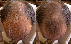 Hair prp treatment