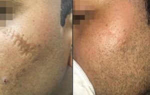 Scar removal treatment