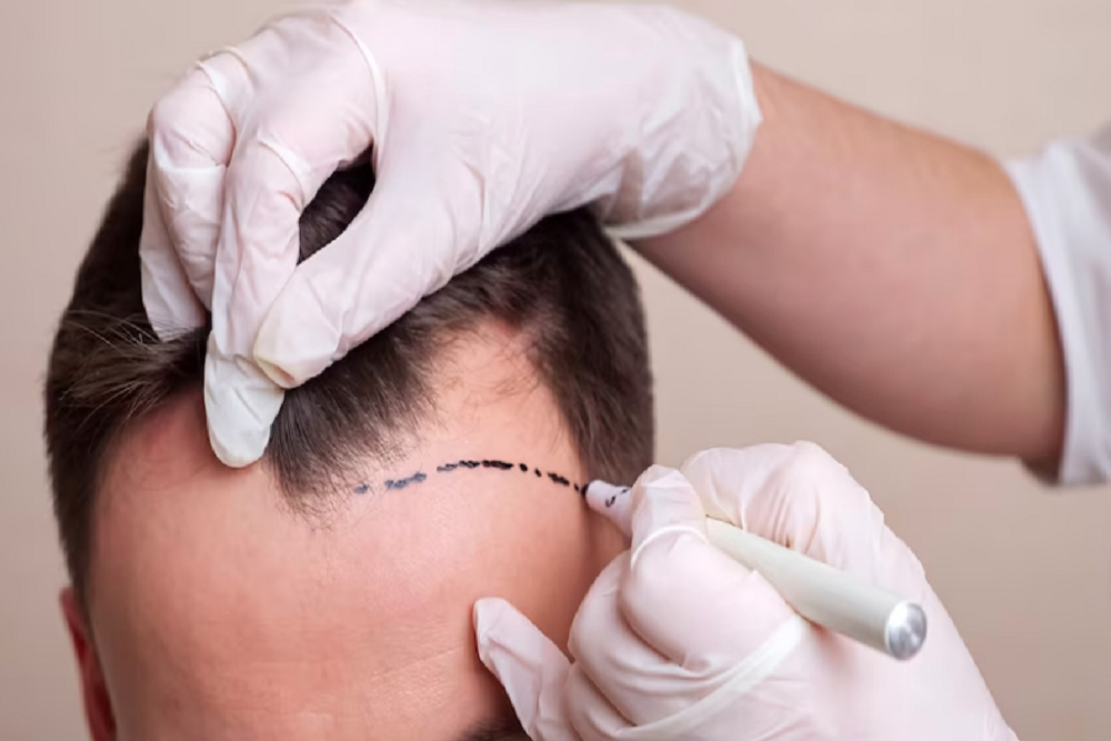 Preparing for Your Hair Transplant: Essential Pre-Surgical Guidelines