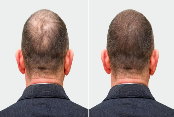 Hair Regrowth at haror wellness