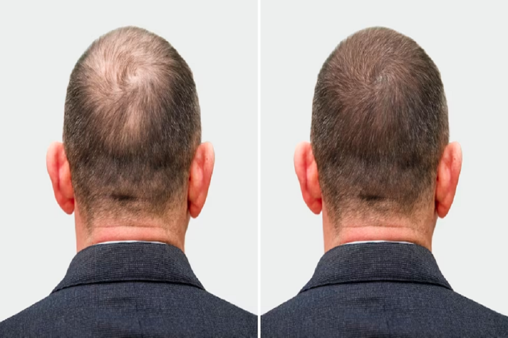 How Transplanted Hair Grows: A Visually Comprehensive Guide