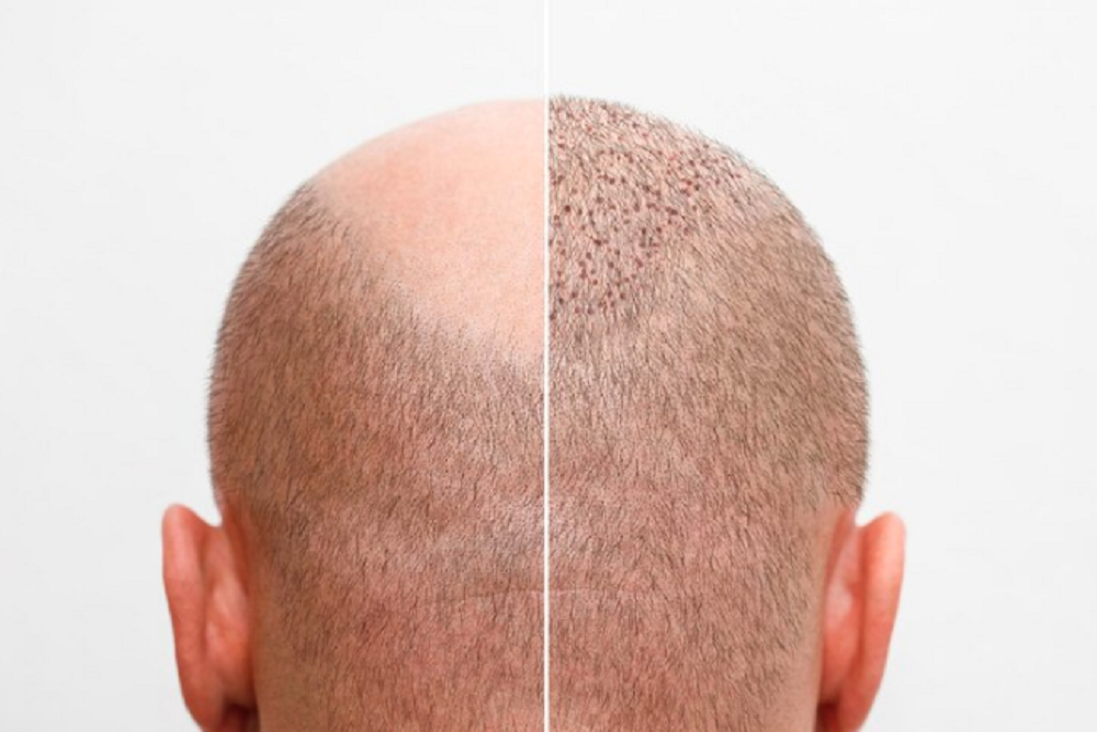 Does Punch Size Matter in FUE Hair Transplant?