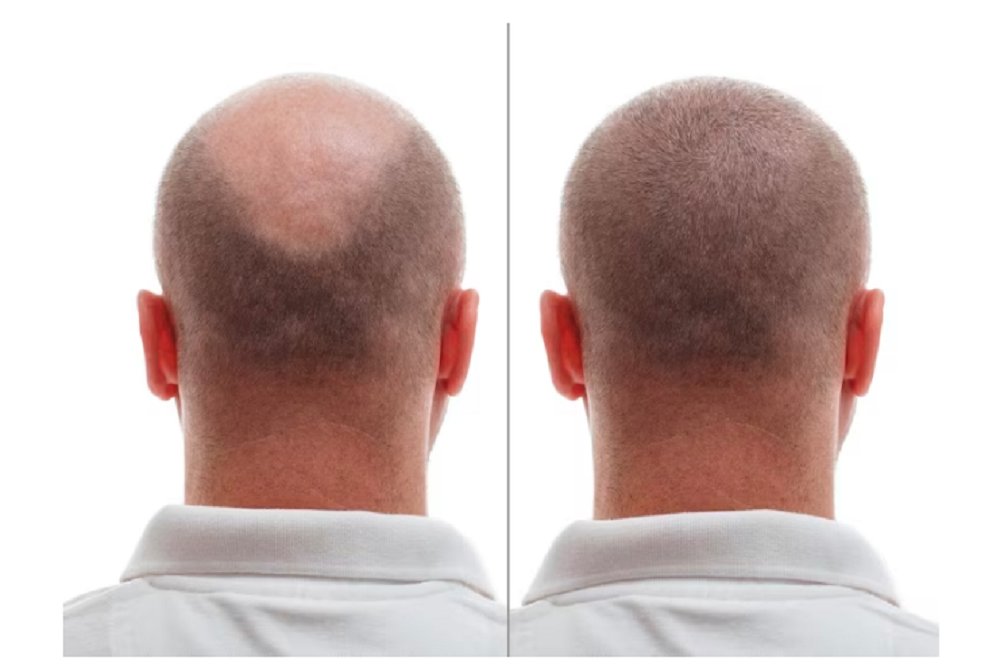 5 Common Occurrences Post Hair Transplant