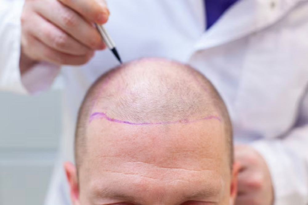 How Hair Transplant Can Boost Your Confidence