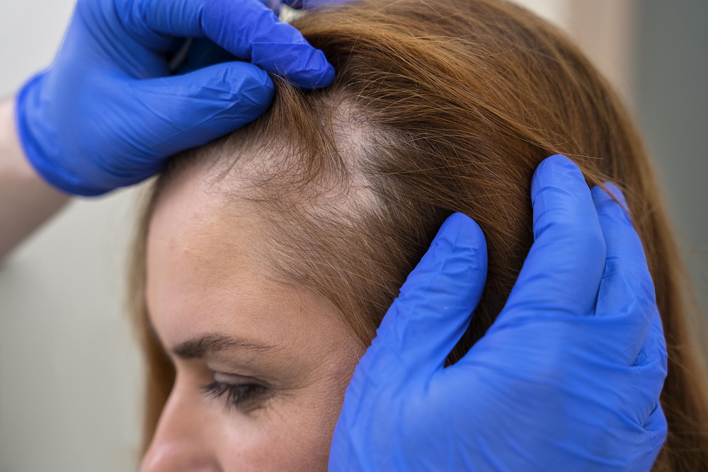 Uncover Solutions with the Best Doctor for Hair Loss in Delhi