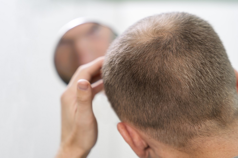Unveiling the Best Hair Transplant Doctor in Delhi