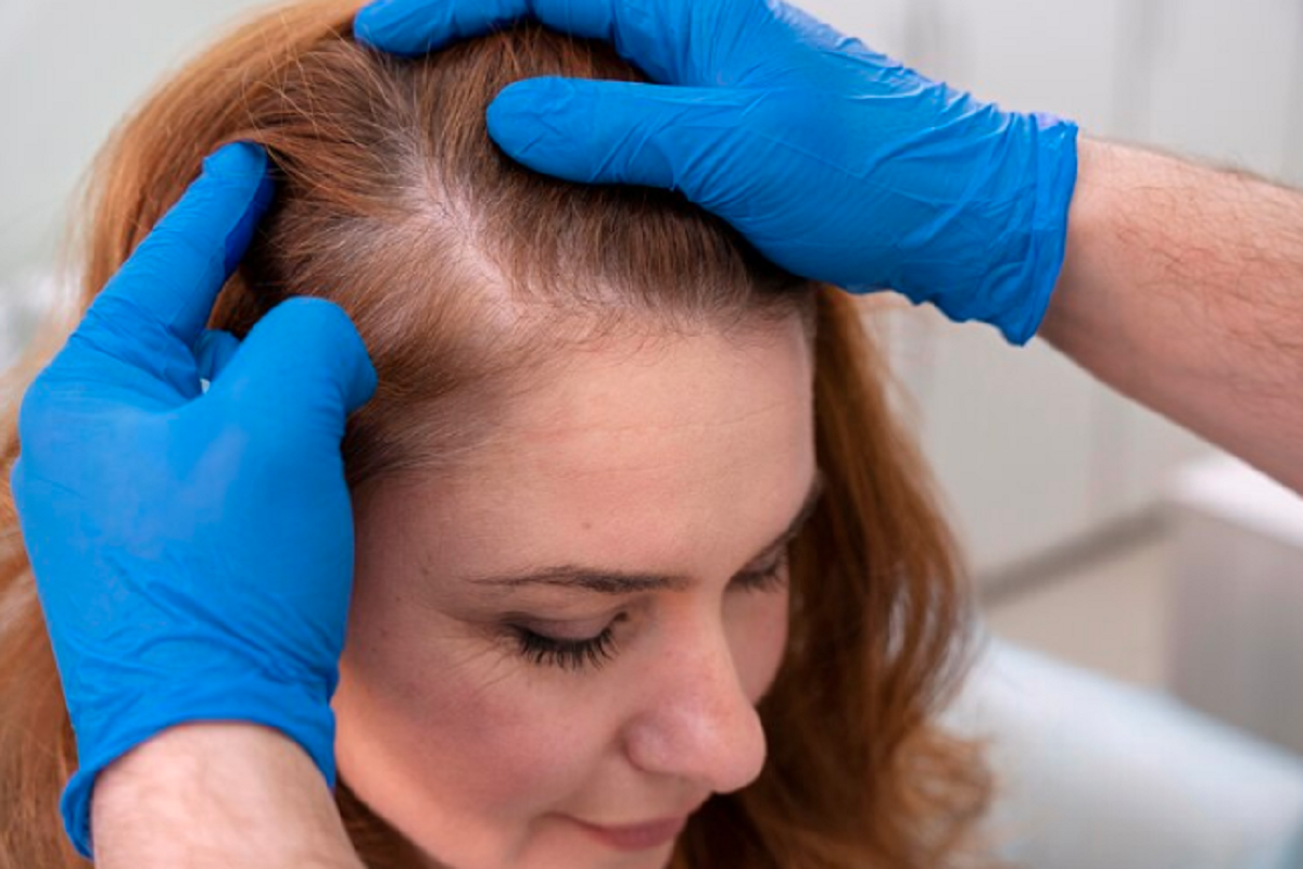 Understanding Hair Loss and Treatment Options in Delhi