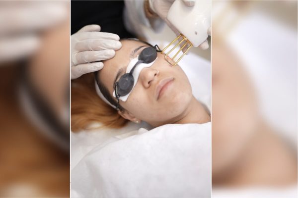 Haror treatments_Laser Toning for Face copy 5