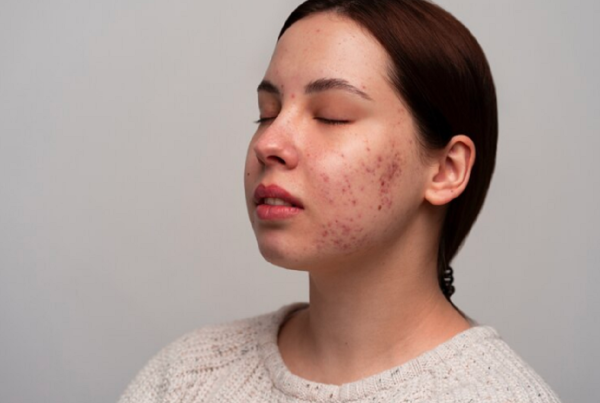 Laser Treatment for Pimples and Scars in Delhi