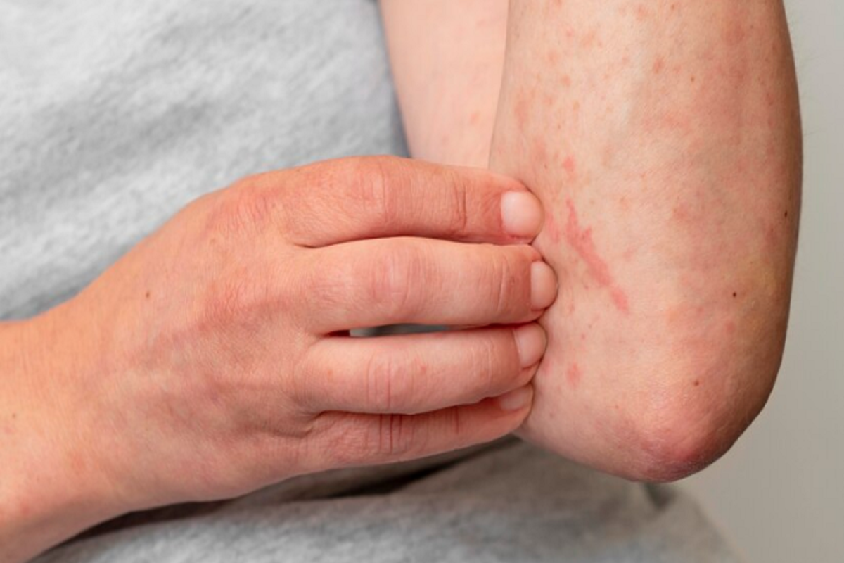 Effective Ways to Reduce and Remove Chickenpox Scar