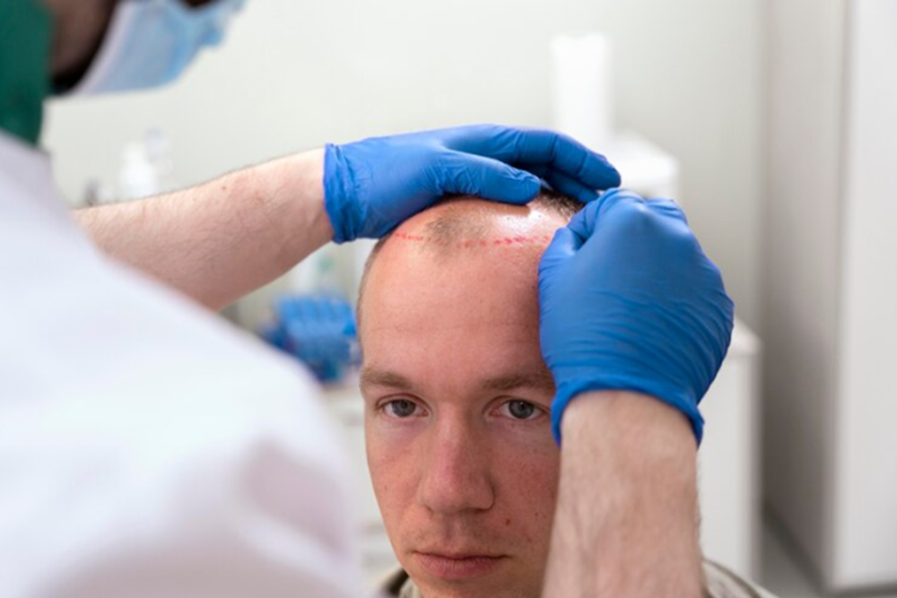 Finding the Best Clinic for Your Hair Transplant Needs in Delhi