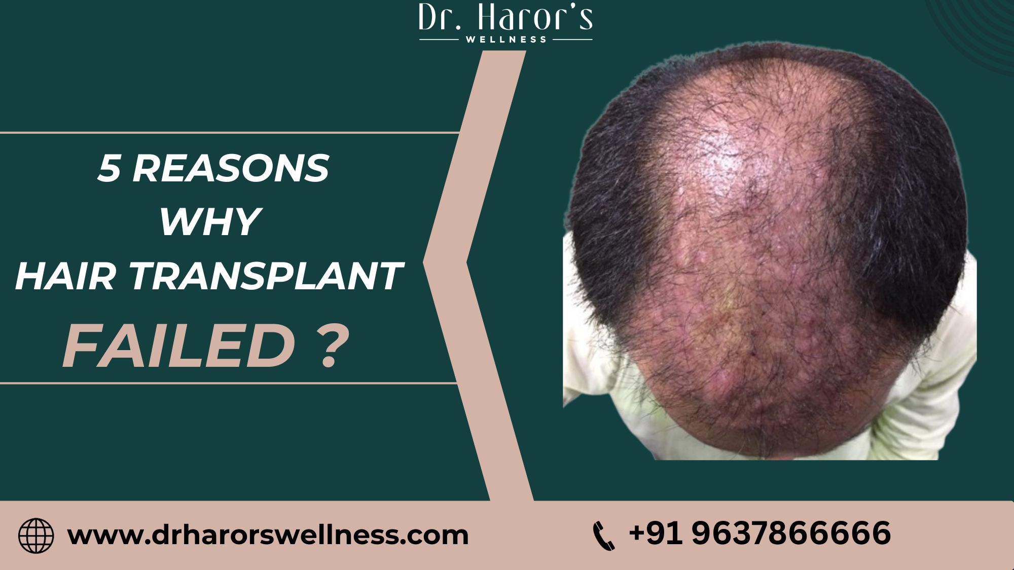 5 Reasons of Failed Hair Transplant : A Comprehensive Guide