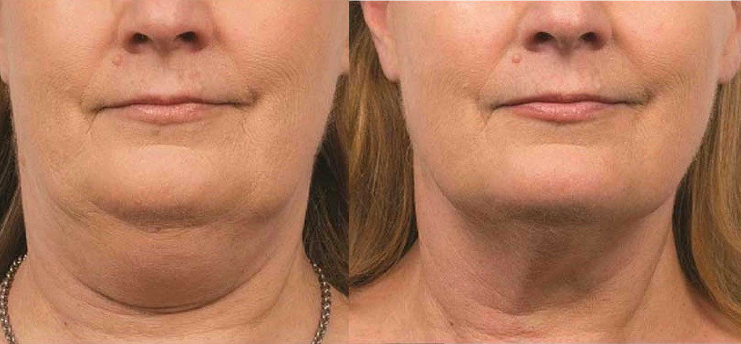 No Surgery, No Downtime : Double Chin Removal  Treatment