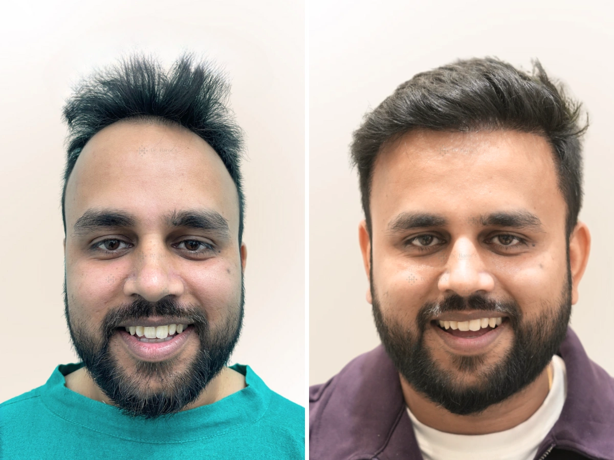 Hair Transplant Delhi