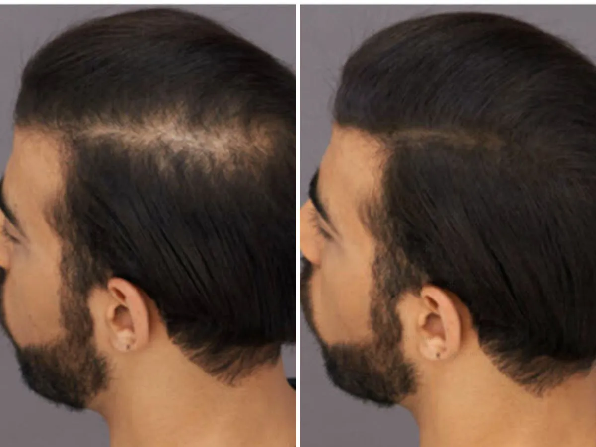 Hair Transplant Results 