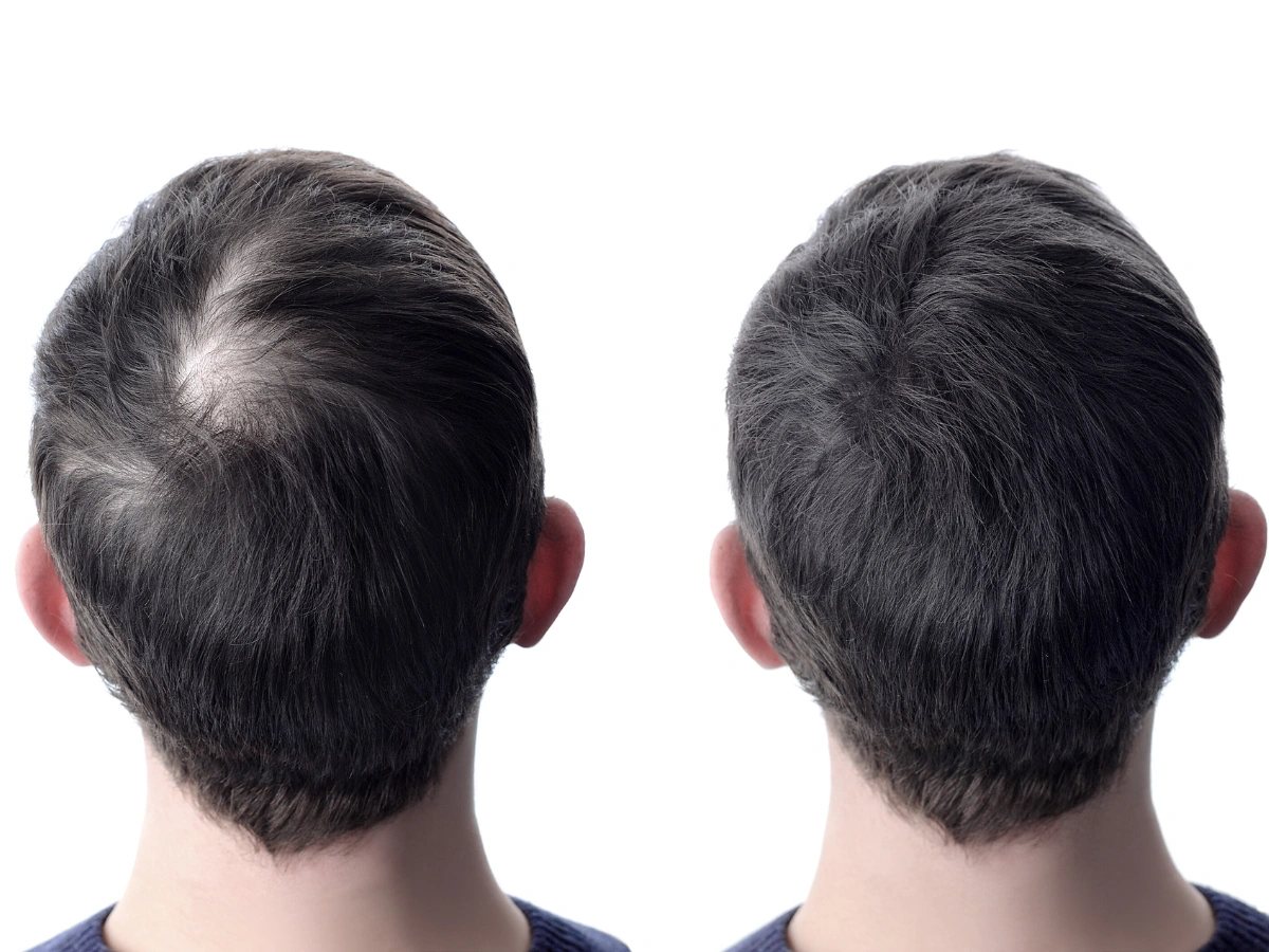 Natural Hair Transplant Results 