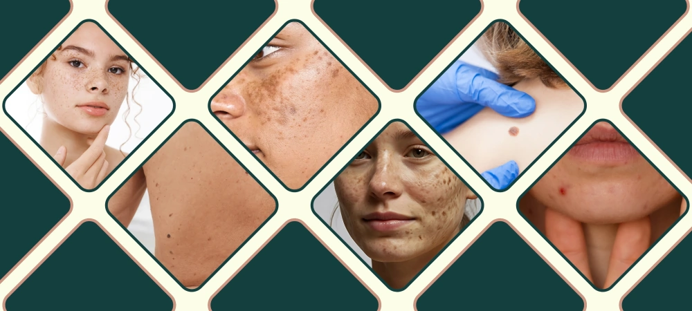 pigmentation removal treatment