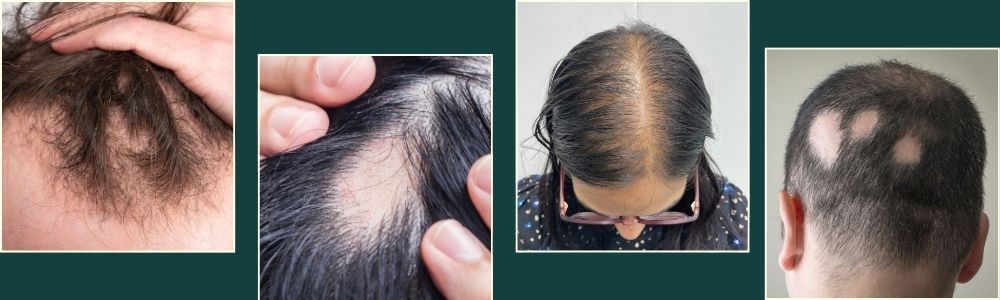 Who is a Good Candidate for Mesotherapy Hair Loss Treatment