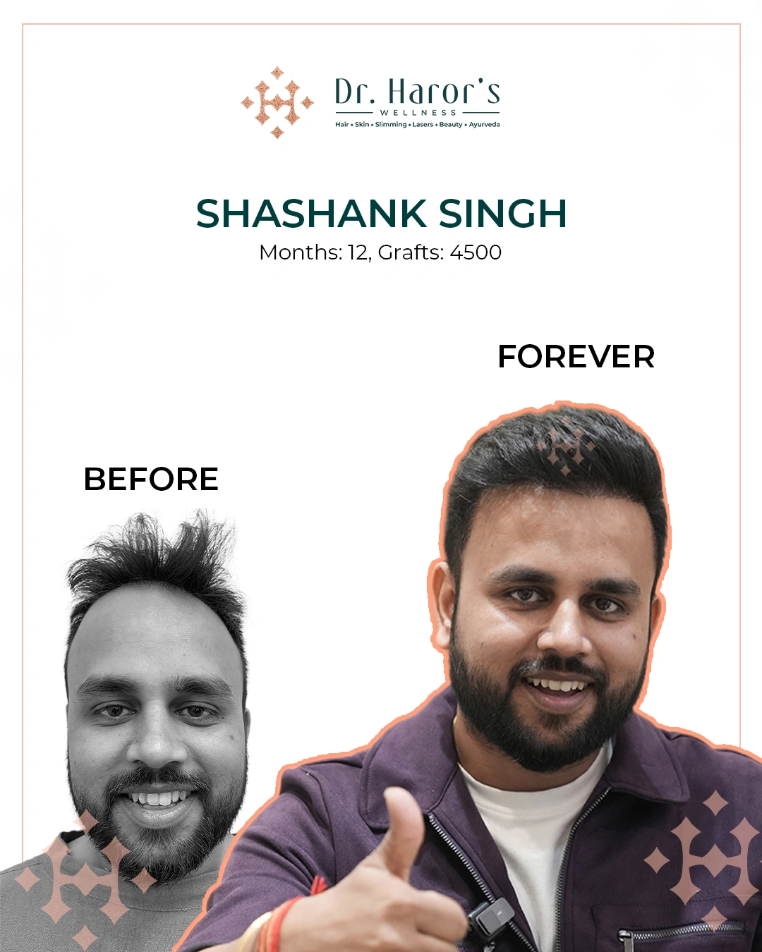 hair transplant in India