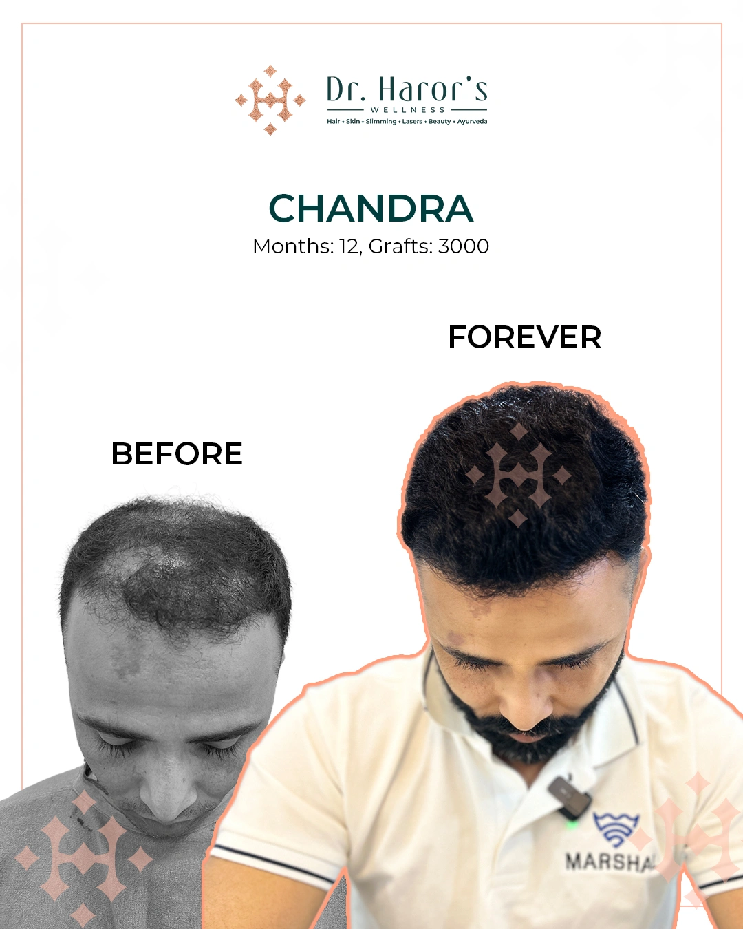 hair transplant in Delhi NCR