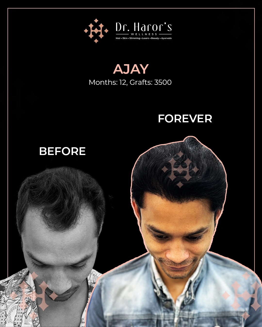 Hair Transplant in Delhi NCR India