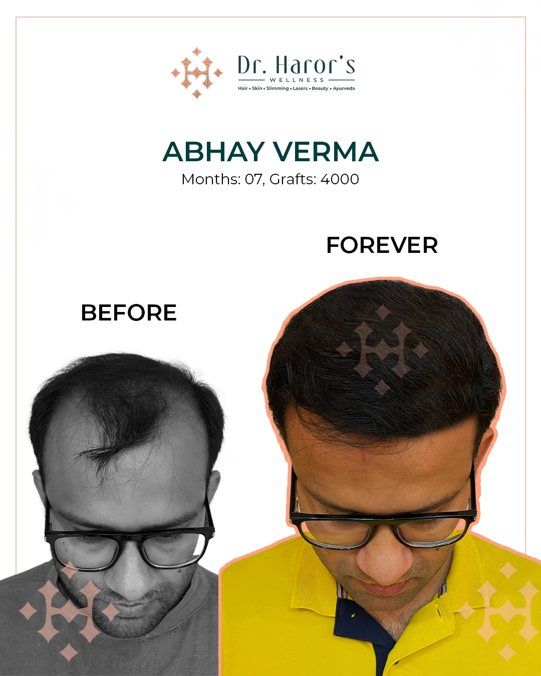 Hair Transplant in Delhi NCR India