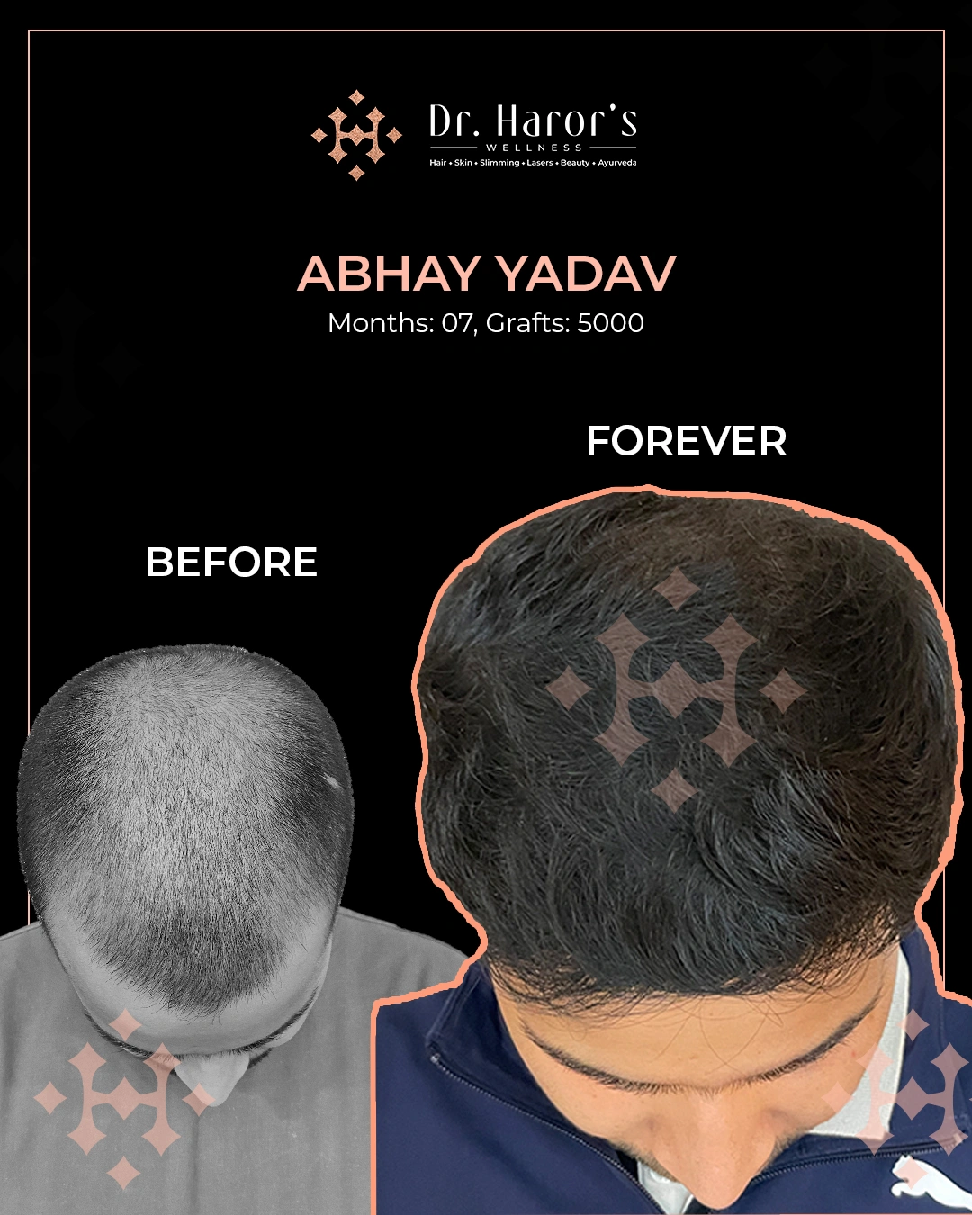 Hair Transplant in Delhi NCR India