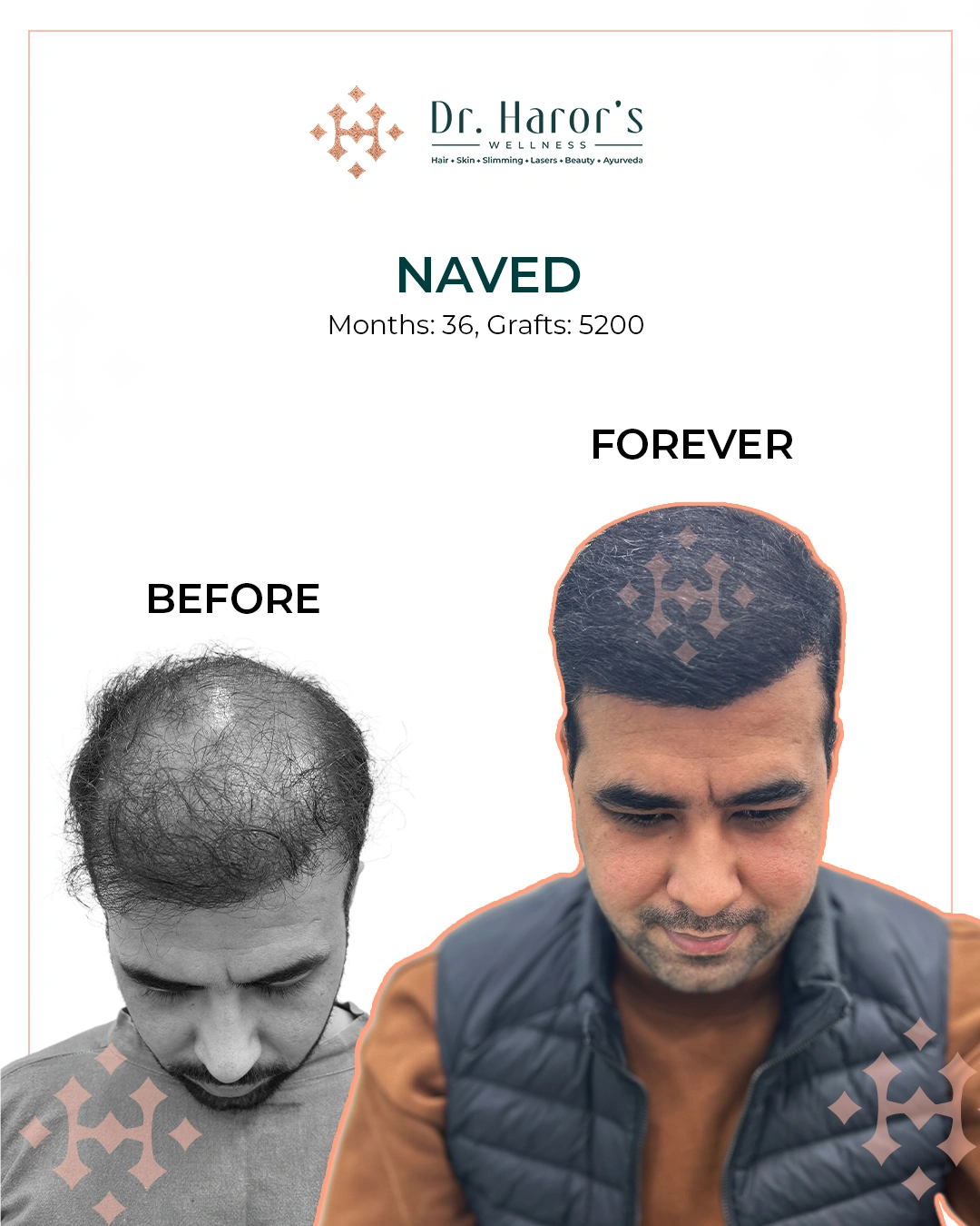 Hair Transplant in Delhi NCR India