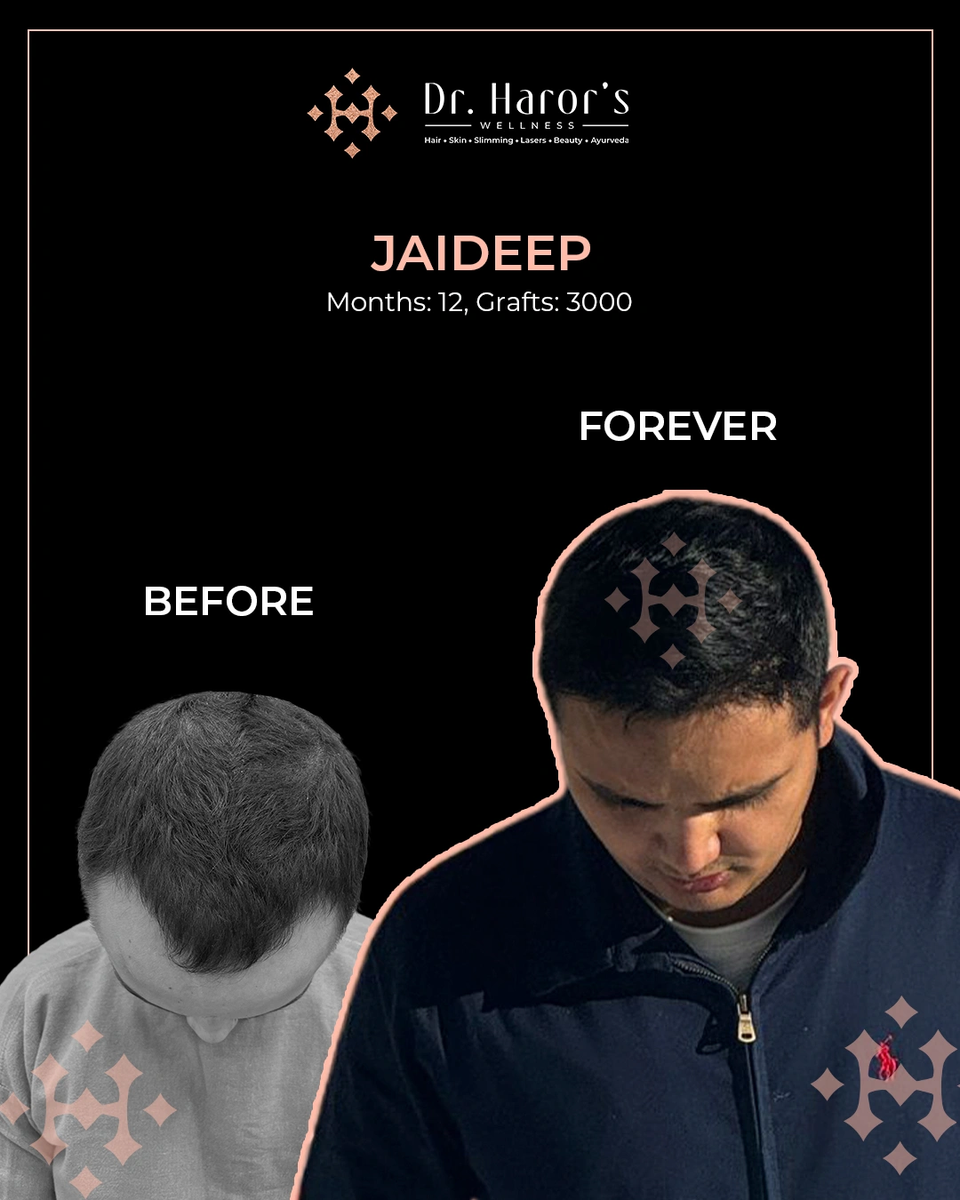 Hair Transplant in Delhi NCR India