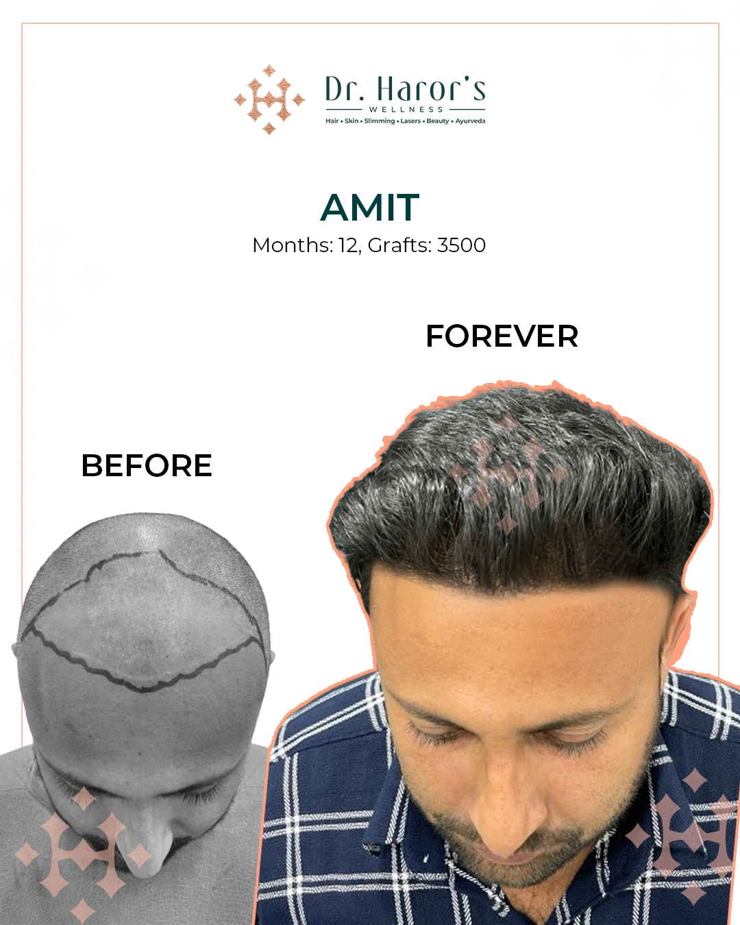 Hair Transplant in Delhi NCR India