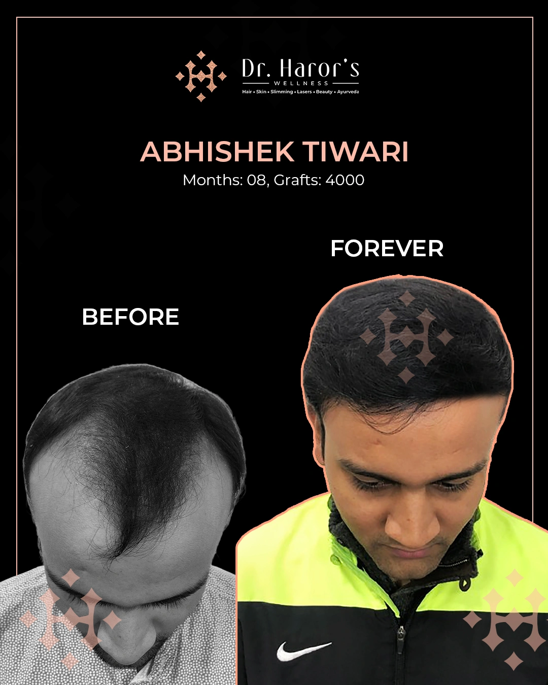Hair Transplant in Delhi NCR India