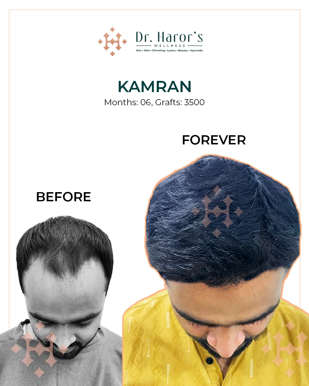 Hair Transplant in Delhi NCR India