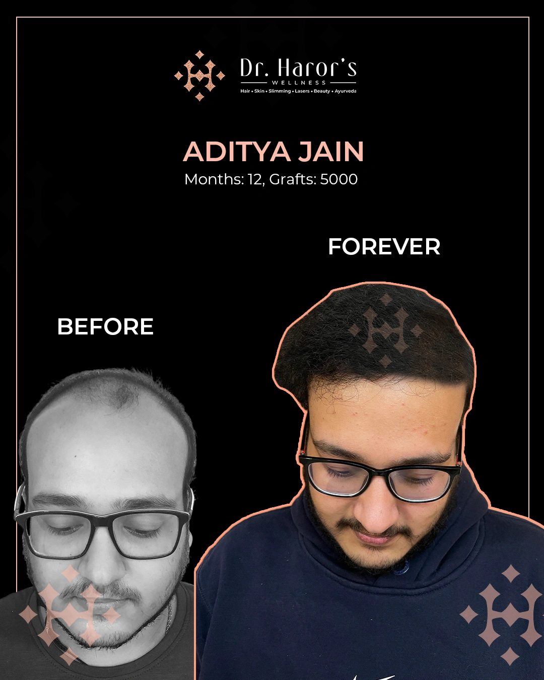 Hair Transplant in Delhi NCR India