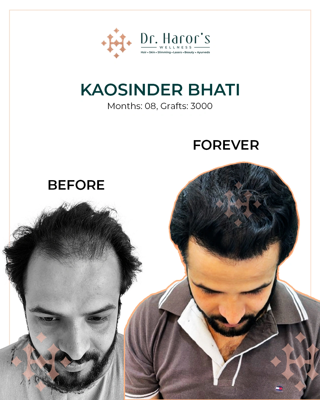 Hair Transplant in Delhi NCR India