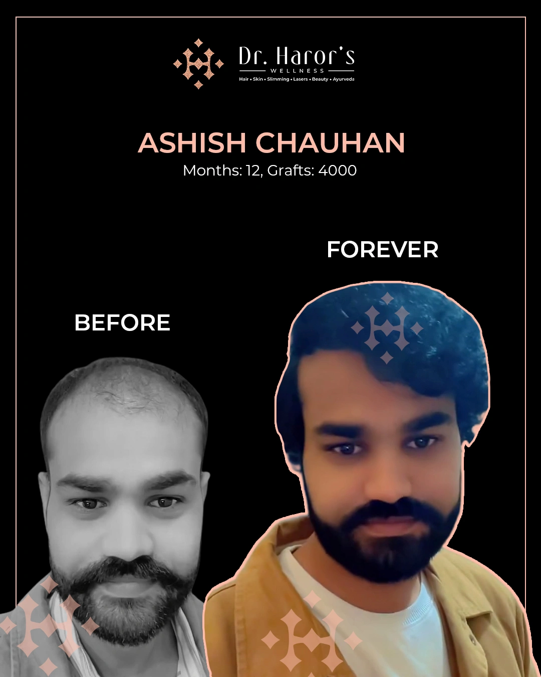 Hair Transplant in Delhi NCR India