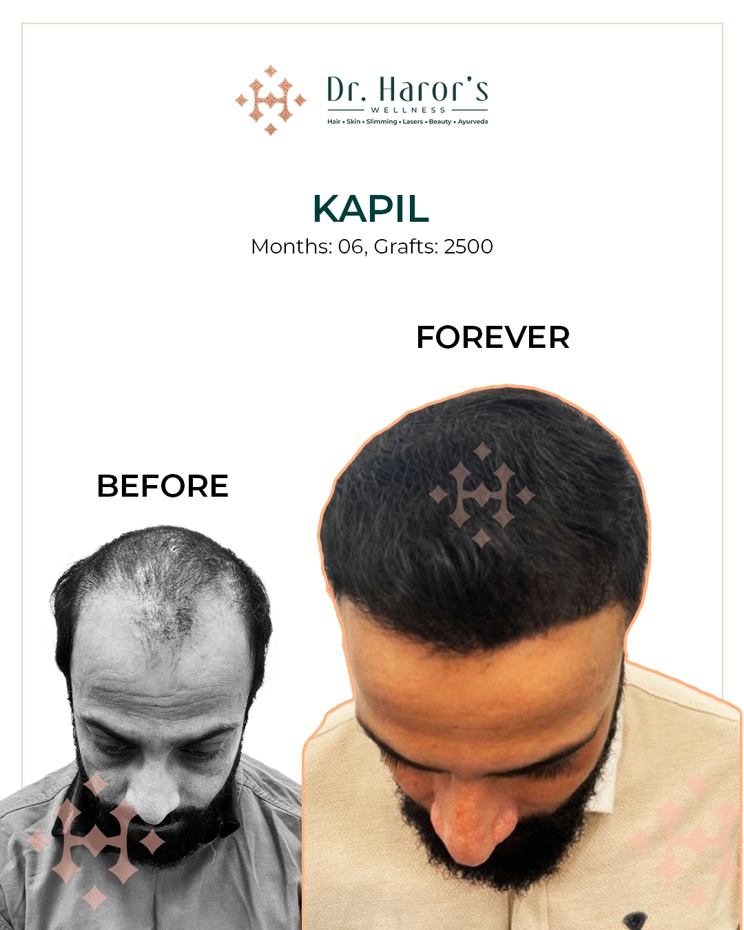 Hair Transplant in Delhi NCR India