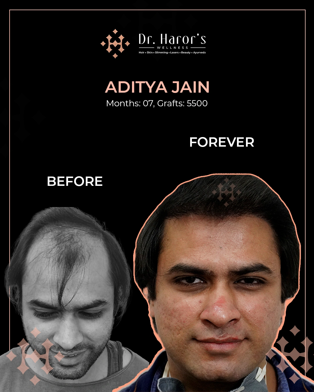 Hair Transplant in Delhi NCR India