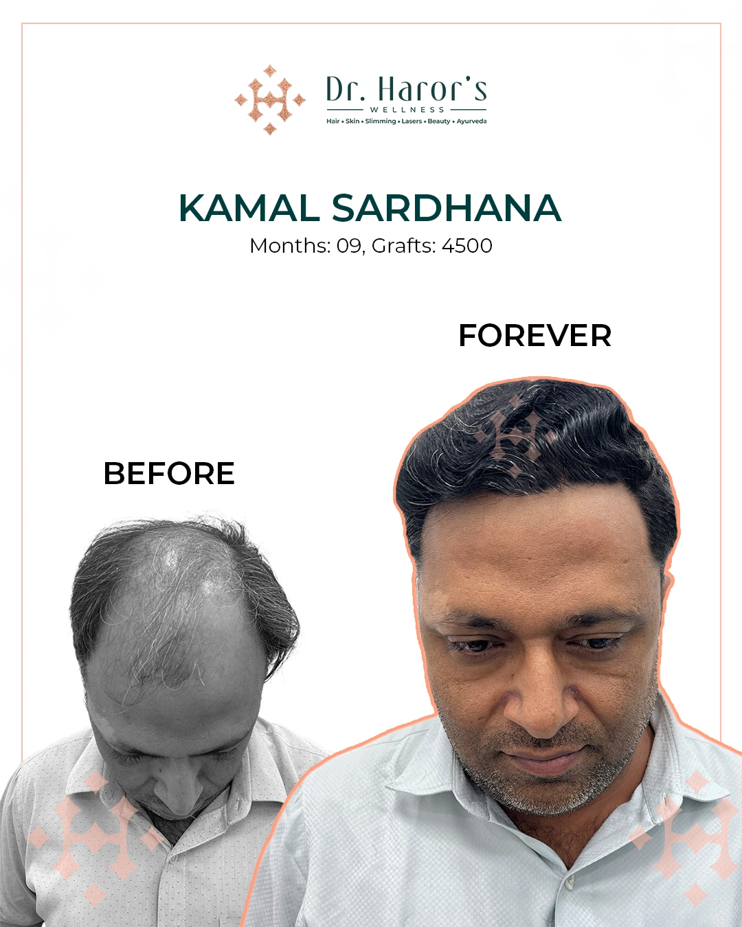 Hair Transplant in Delhi NCR India