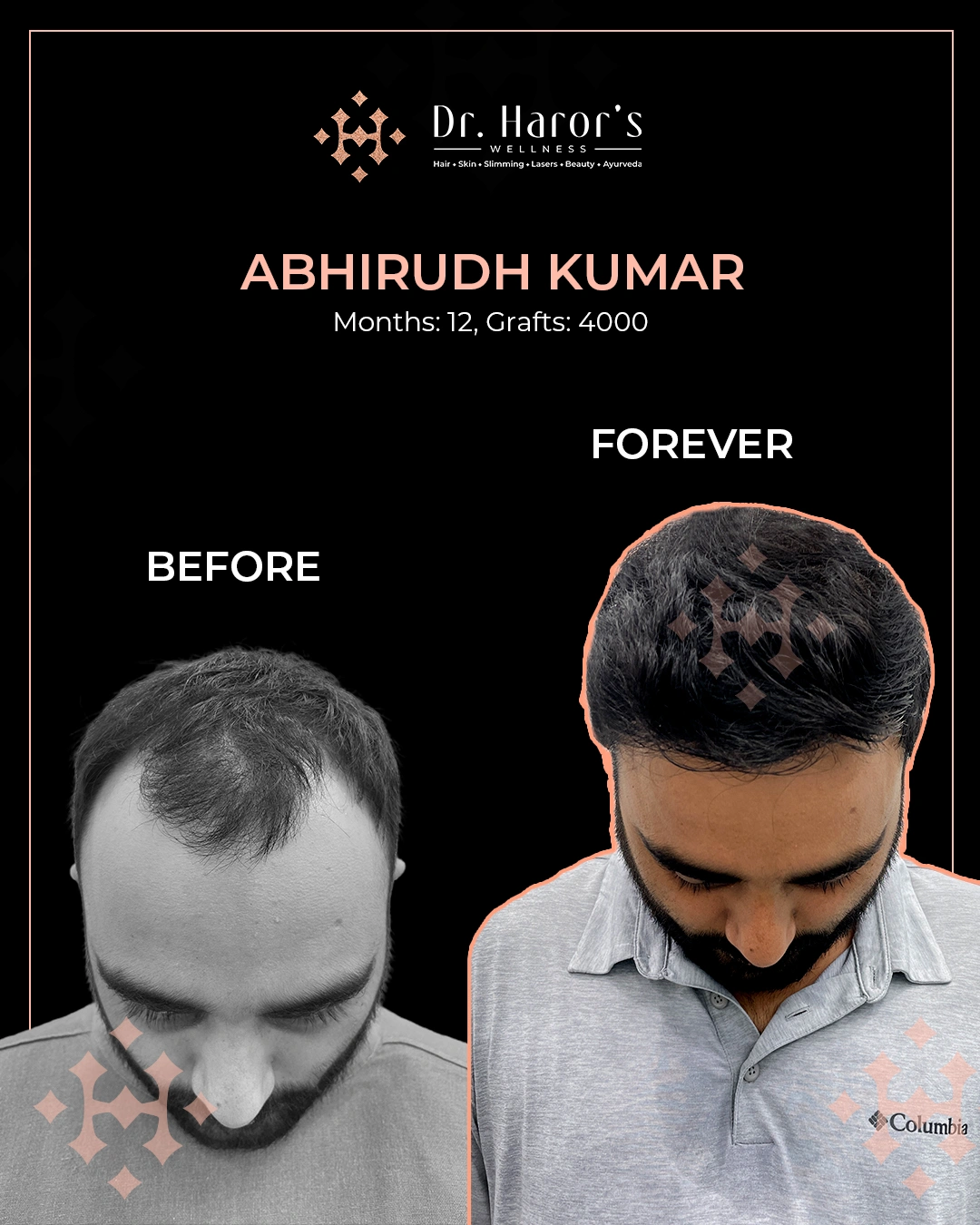 Hair Transplant in Delhi NCR India