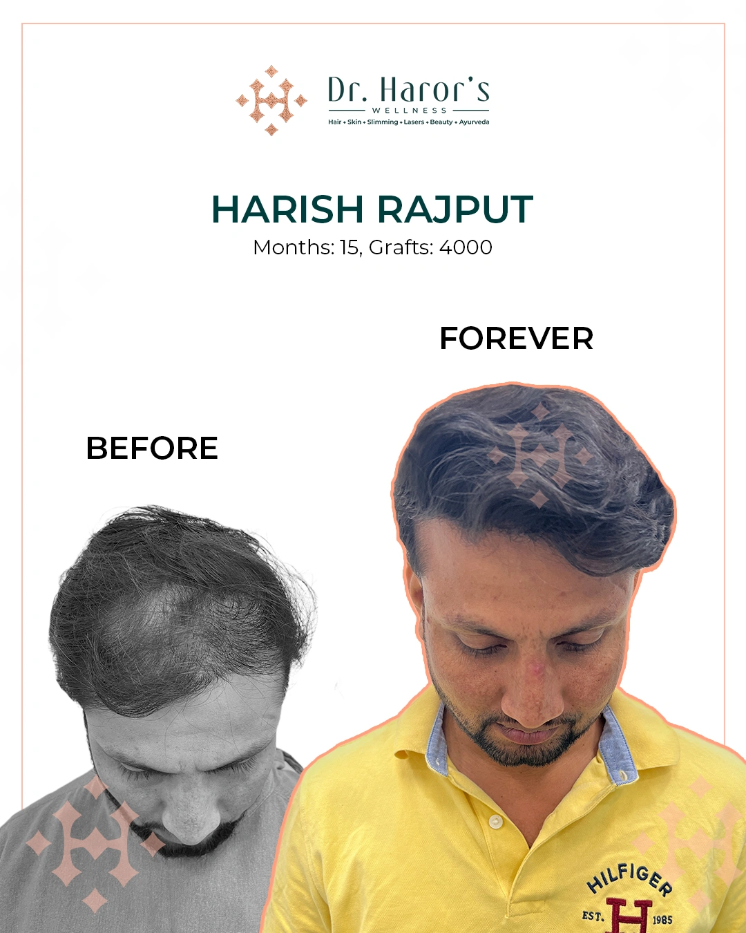 Hair Transplant Results in Delhi NCR India
