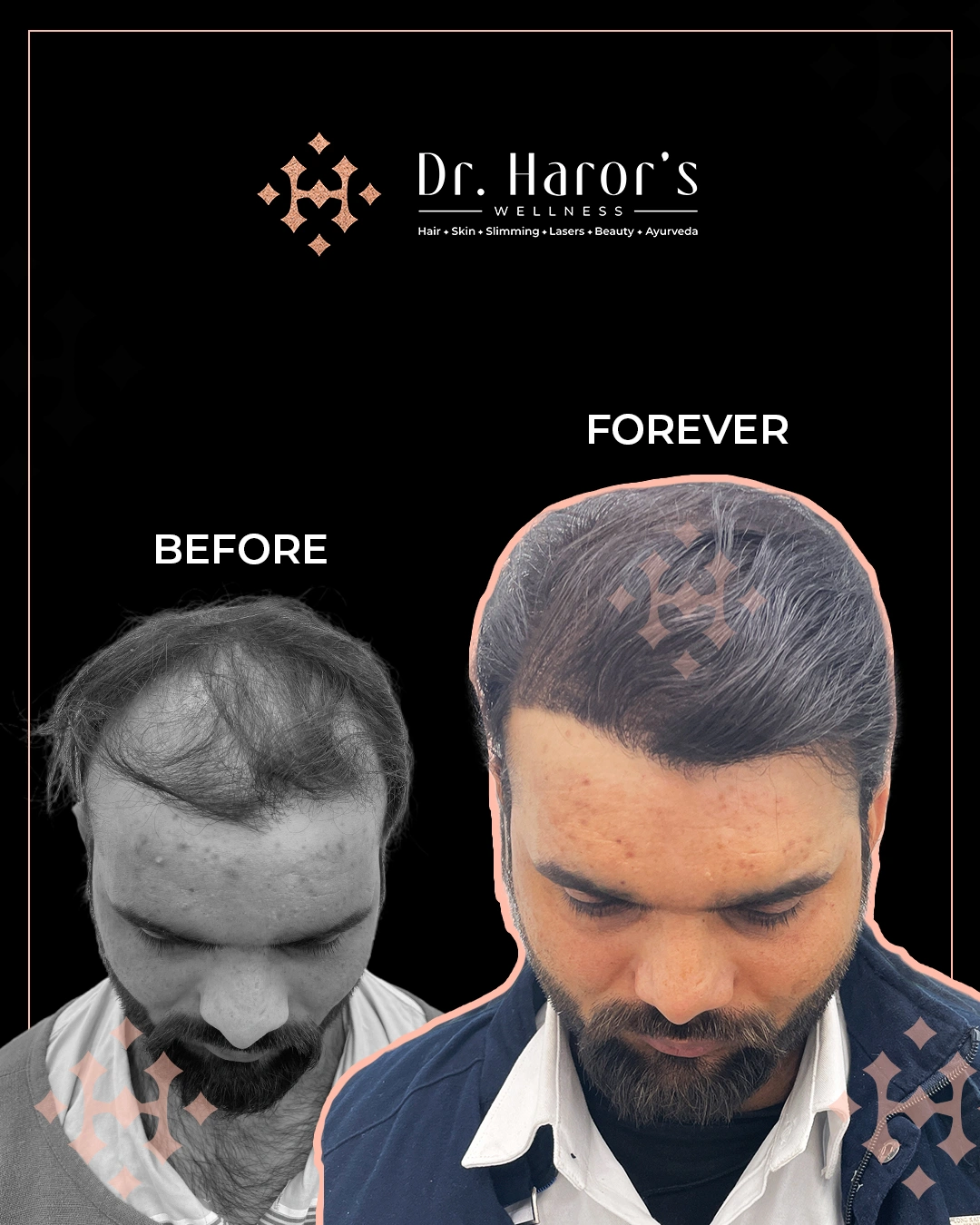 Hair Transplant Results in Delhi NCR India