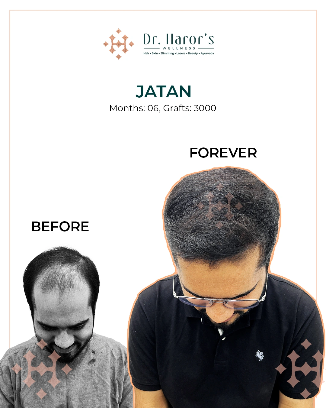 Hair Transplant Results in Delhi NCR India