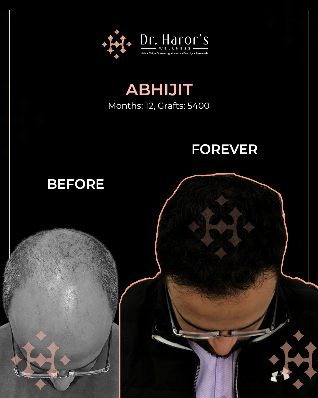 Hair Transplant Results in Delhi NCR India