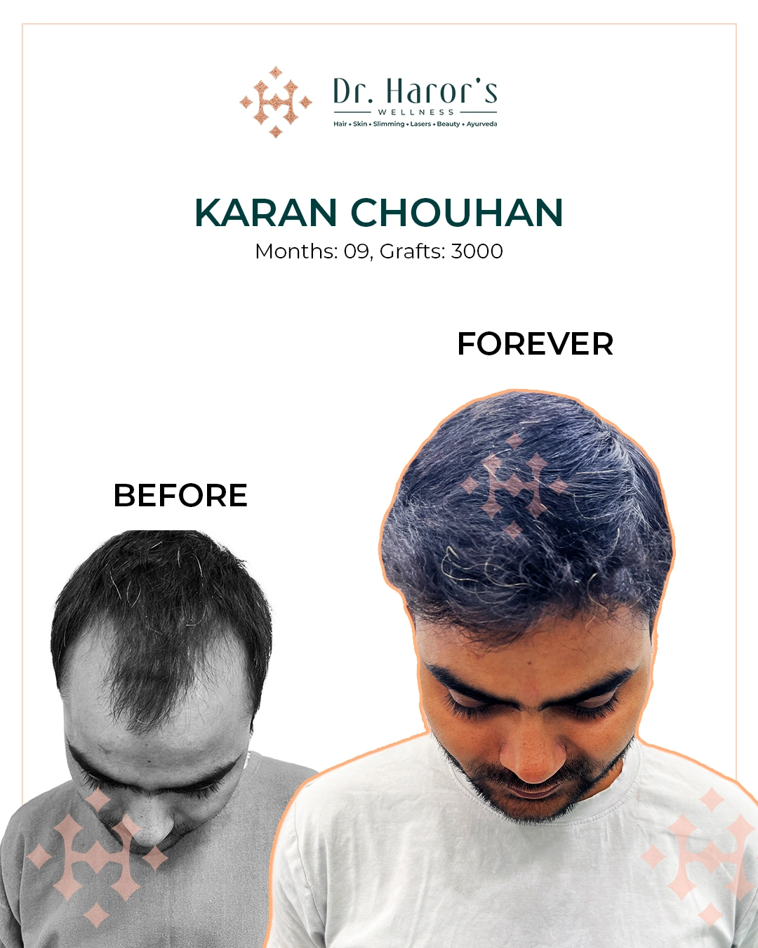 Hair Transplant Results in Delhi NCR India