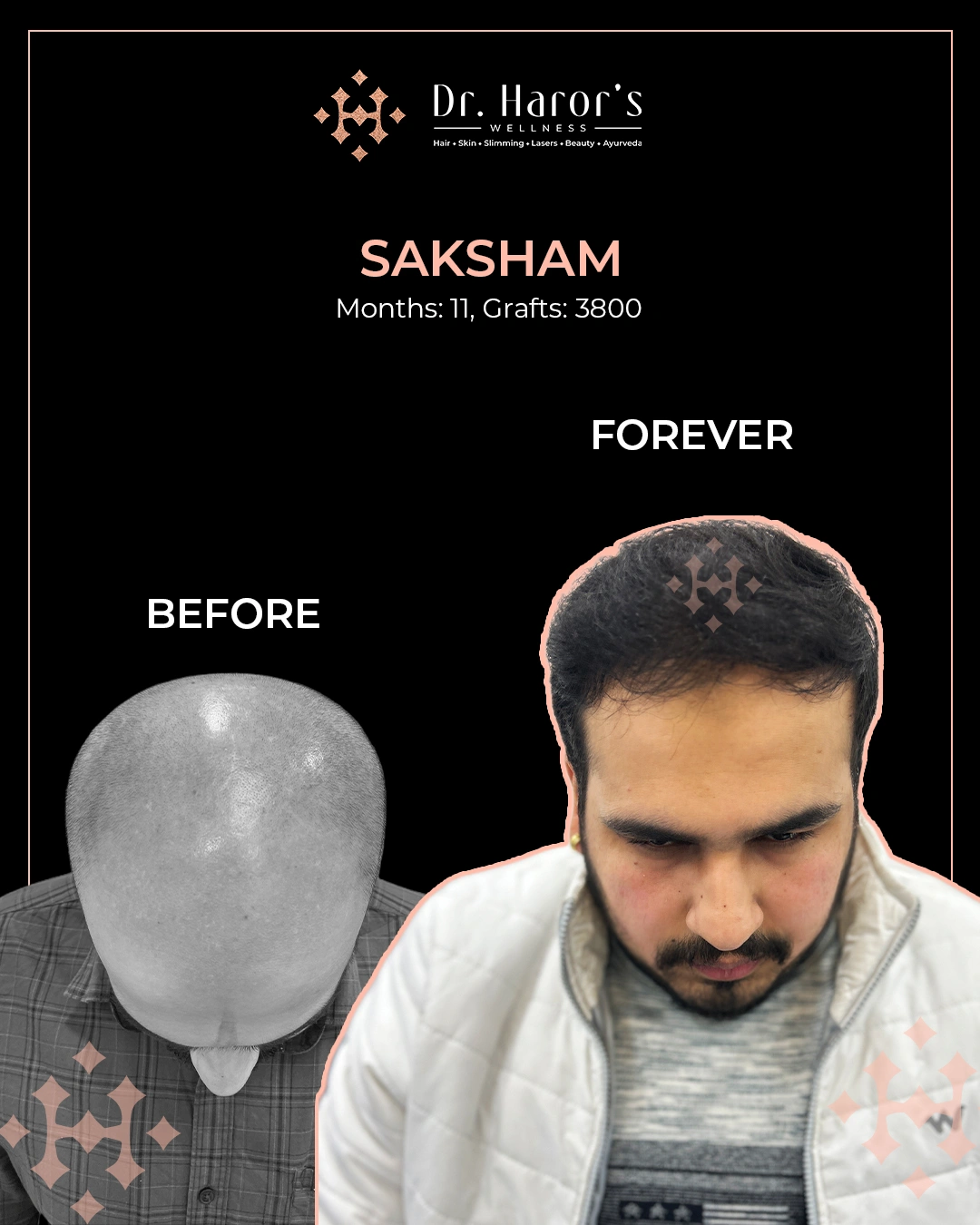 Hair Transplant Results in Delhi NCR India