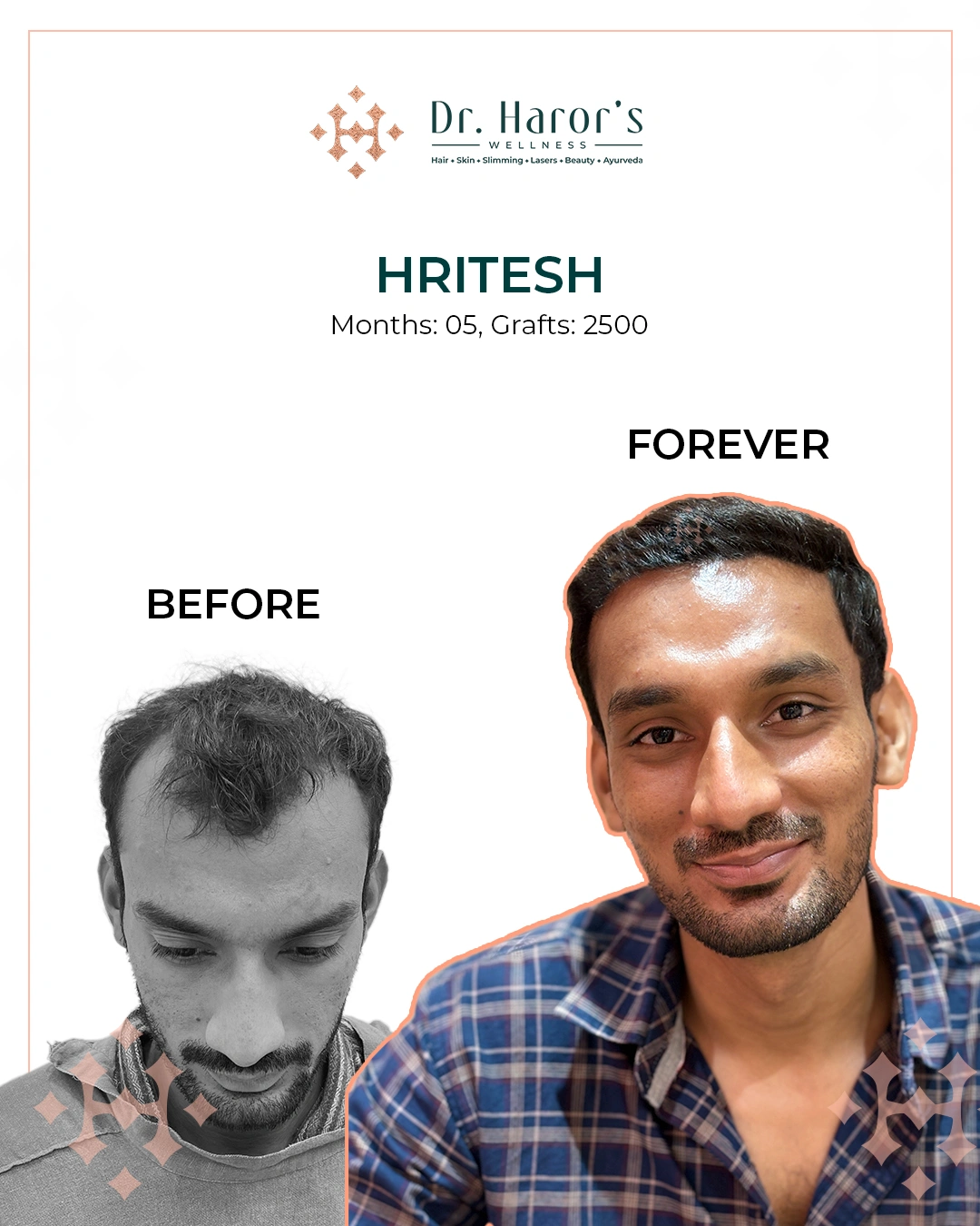 Hair Transplant Results in Delhi NCR India
